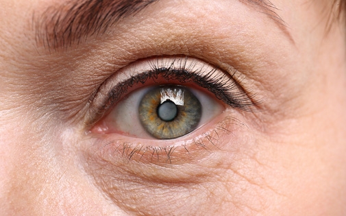 Katarakt Nedir? Belirtileri, Tedavisi