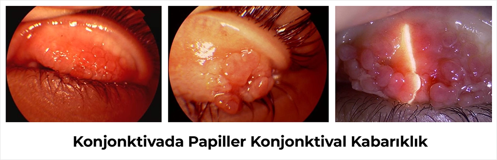 Konjonktivada Papiller Konjonktival Kabarıklık