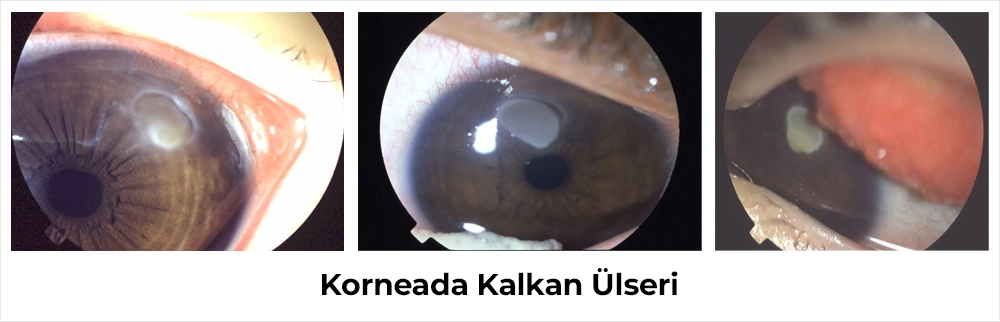 Korneada Kalkan Ülseri