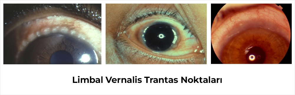 Limbal Vernalis Trantas noktaları