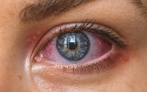 Herpetik Keratit (Göz Uçuğu)