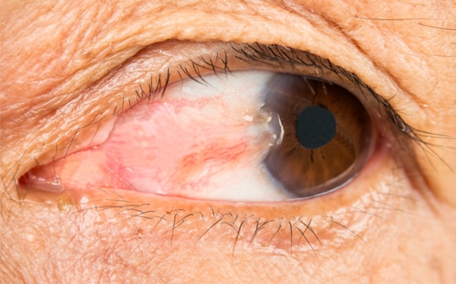 Pterjiyum (Gözde Et Büyümesi)