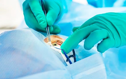 Refraktif Lens Cerrahisi (Saydam Lens)