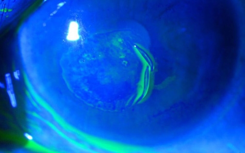 Rekürren Epitel Erozyonu