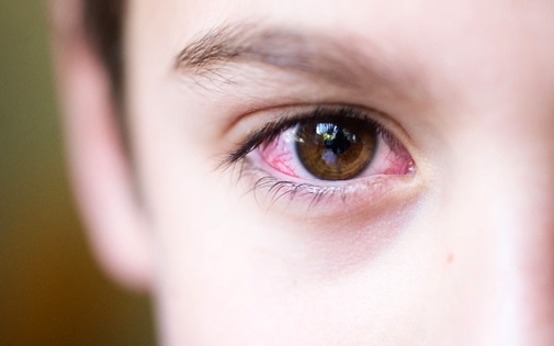 Vernal Keratokonjonktivit