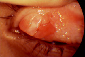 Vernal konjonktivit (bahar keratokonjonktiviti)